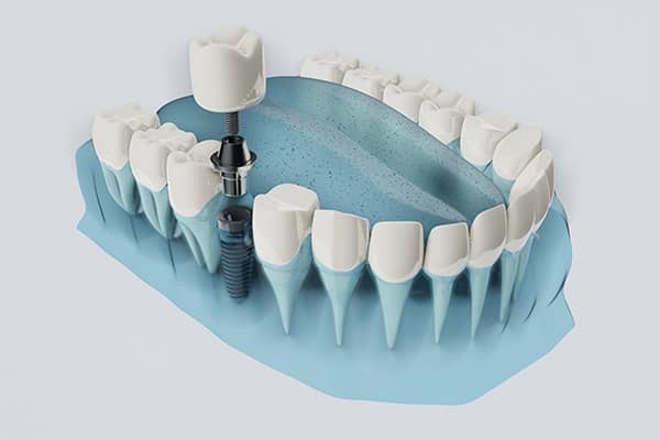 FAQs about Dental Implants from Robert Martini, DDS in Emerson, NJ