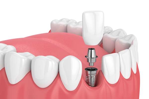 Mini vs. Regular Dental Implants from Robert Martini, DDS in Emerson, NJ