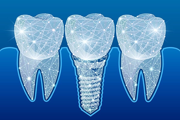 Preventing Complications After Getting Dental Implants from Robert Martini, DDS in Emerson, NJ