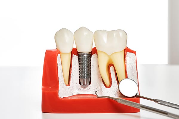 Your Guide to Different Kinds of Dental Implants from Robert Martini, DDS in Emerson, NJ