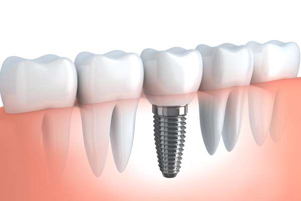 Your Ultimate Guide to Getting Dental Implants from Robert Martini, DDS in Emerson, NJ
