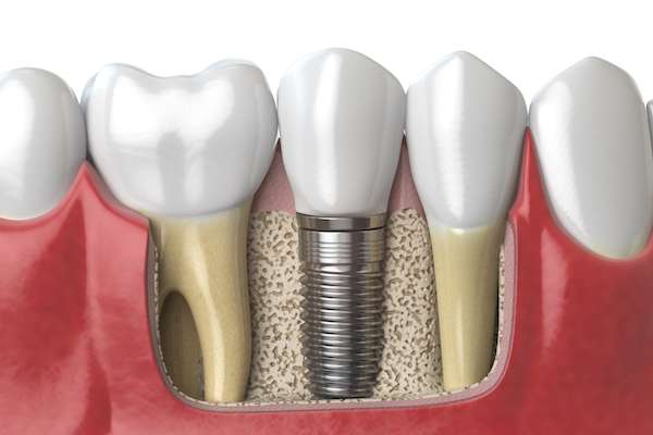 Dental Implants for Replacing Missing Teeth from Robert Martini, DDS in Emerson, NJ