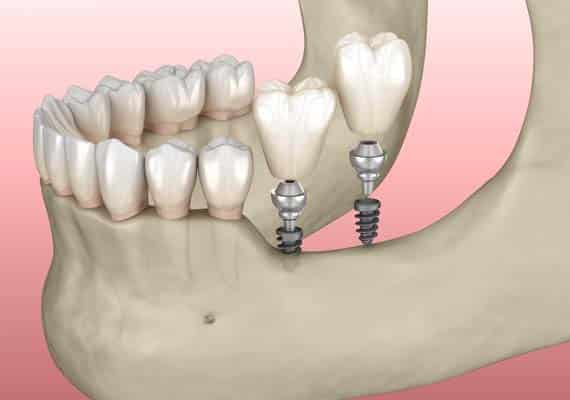 Implant Restoration Emerson, NJ