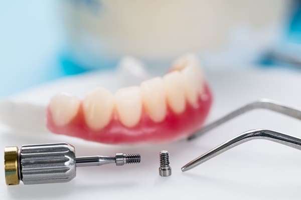 How Many Implants Are Needed For Lower Implant Supported Dentures?