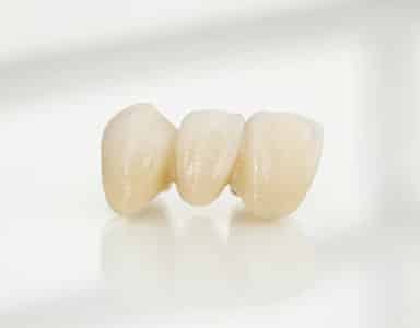 How Long Do Dental Bridges Last?