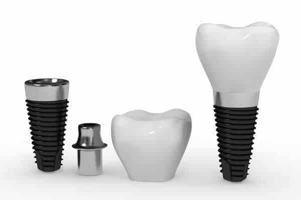 What Are the Parts of Dental Implants