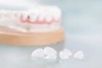 Can Dental Veneers Be Used on Top and Bottom Teeth?