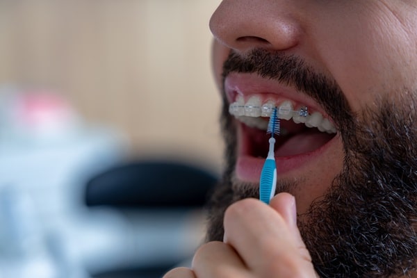 4 Things You May Not Have Known About Clear Braces