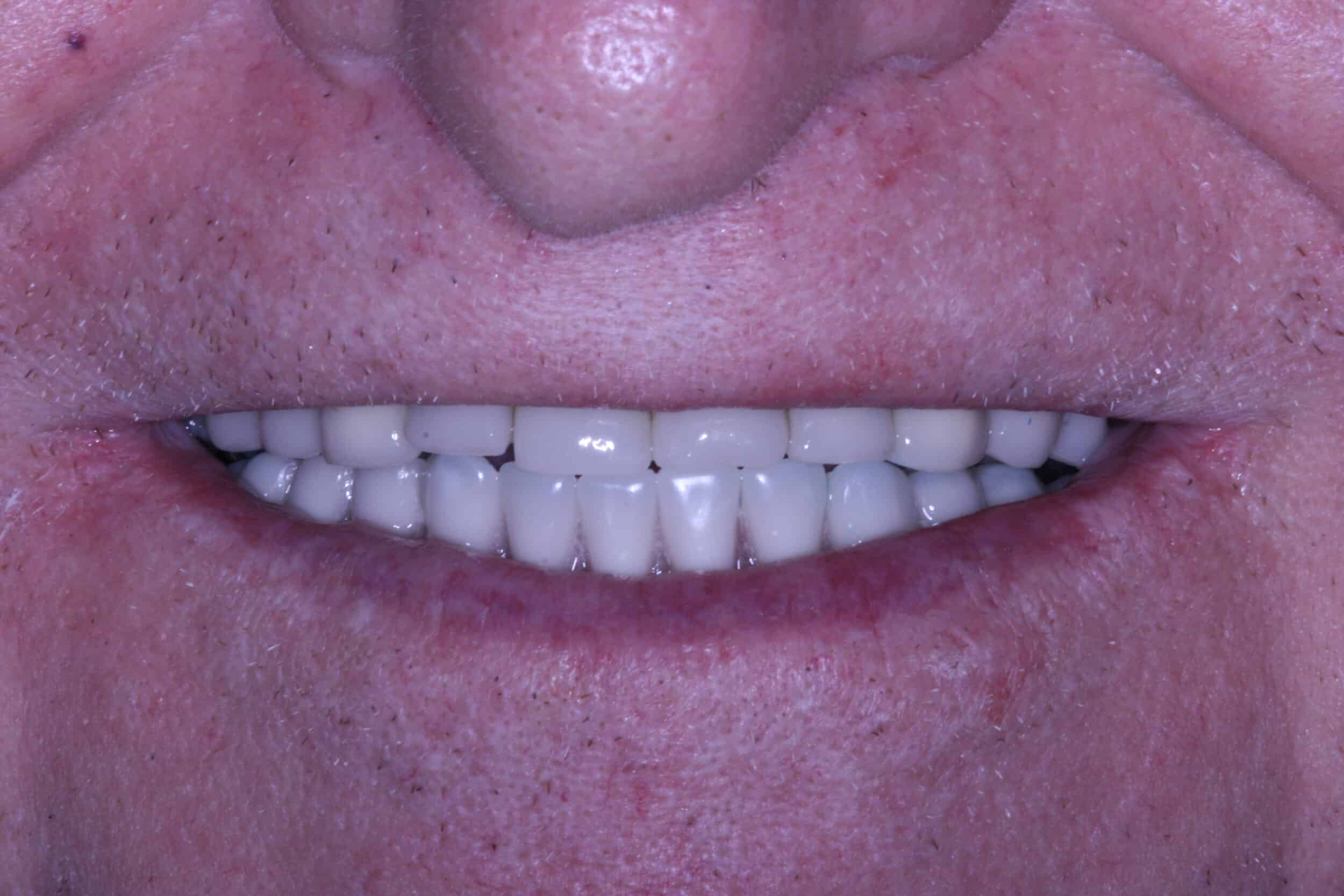 After Image: Dental Implants - front