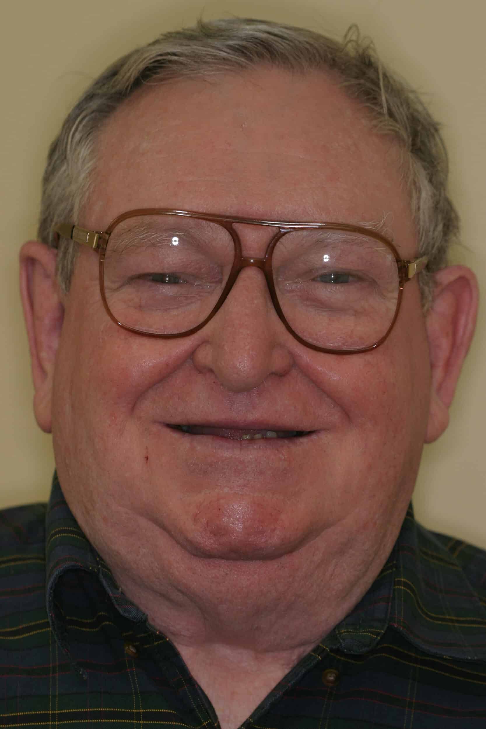 Before Image: Dental Implants - front