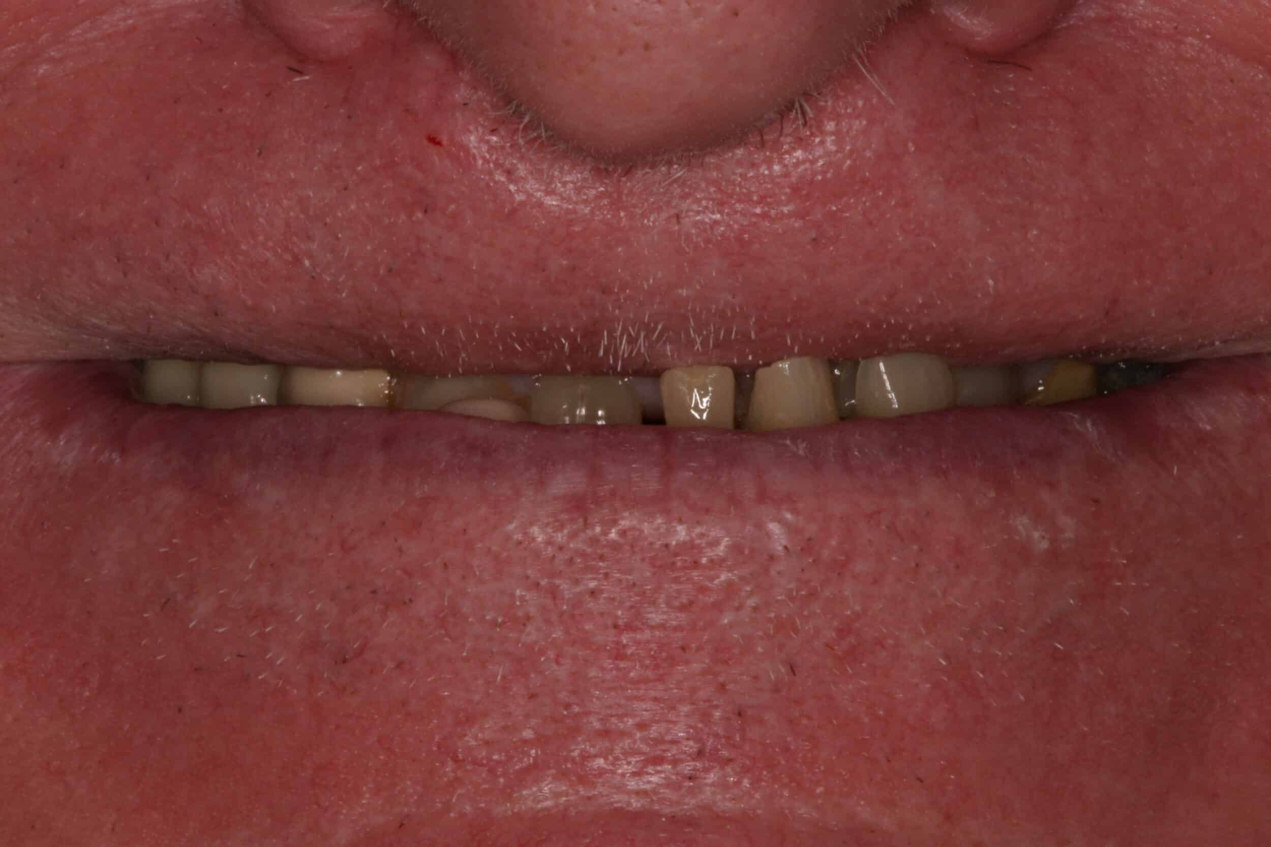 Before Image: Dental Implants - front
