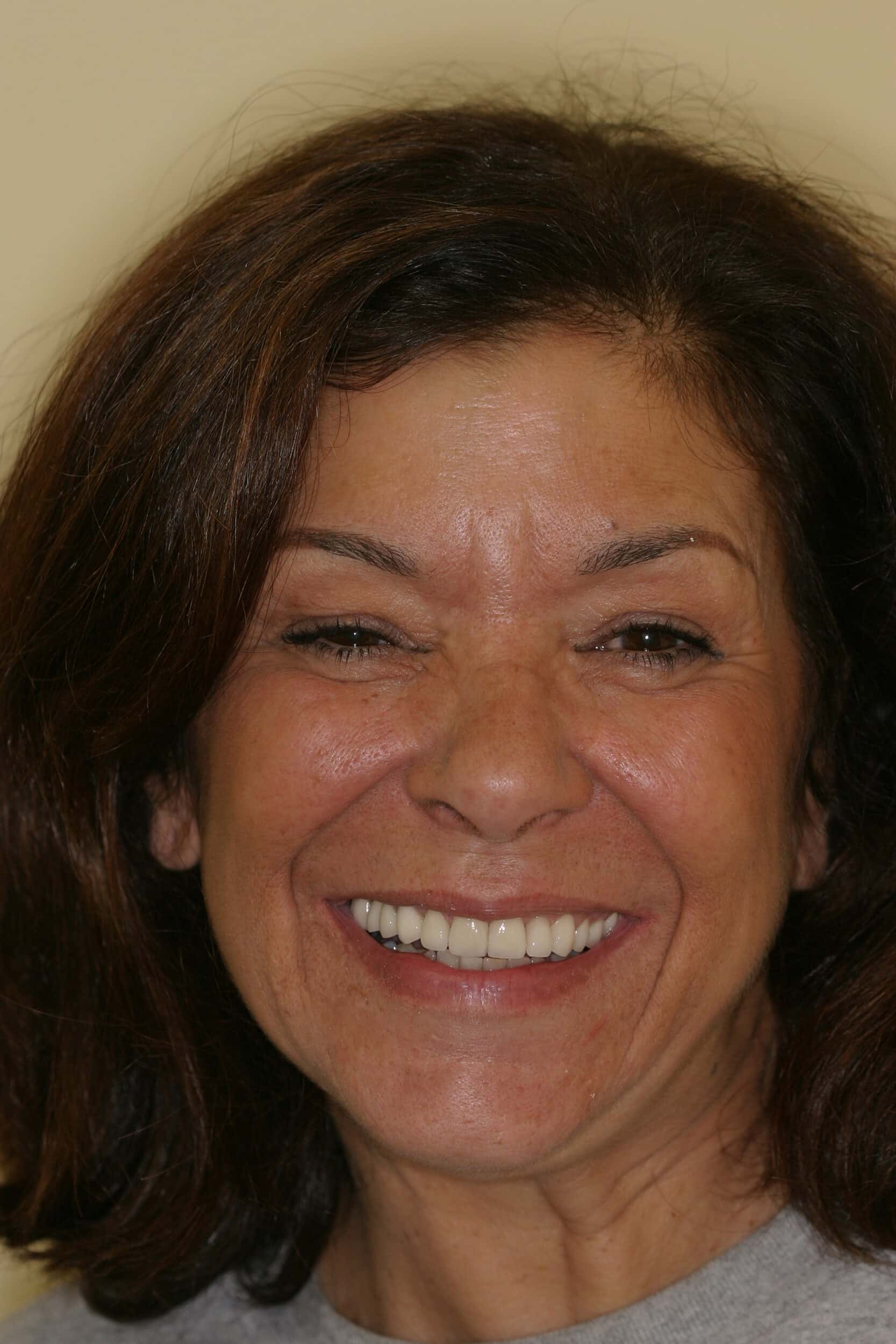 After Image: Dental Implants - front