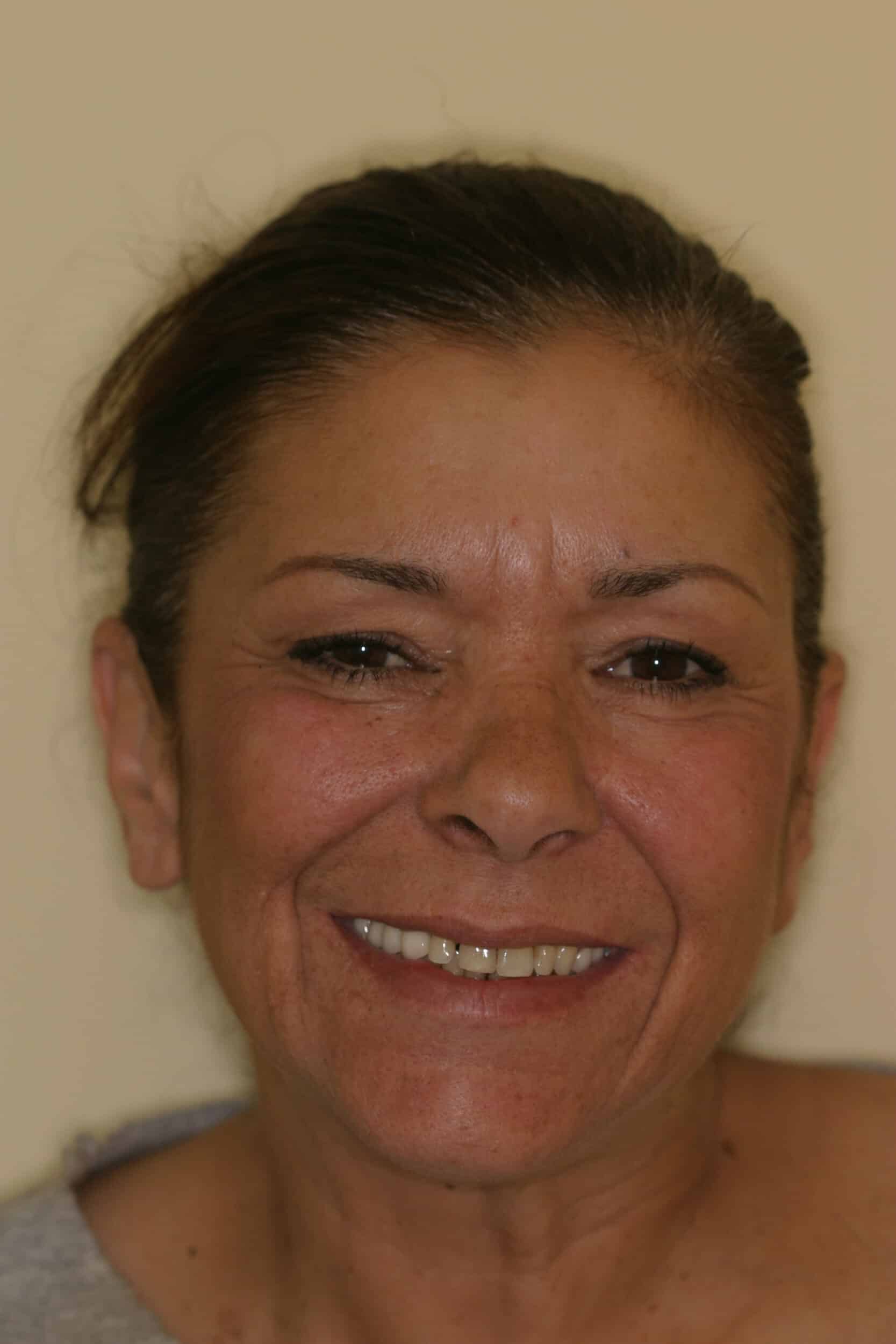 Before Image: Dental Implants - front