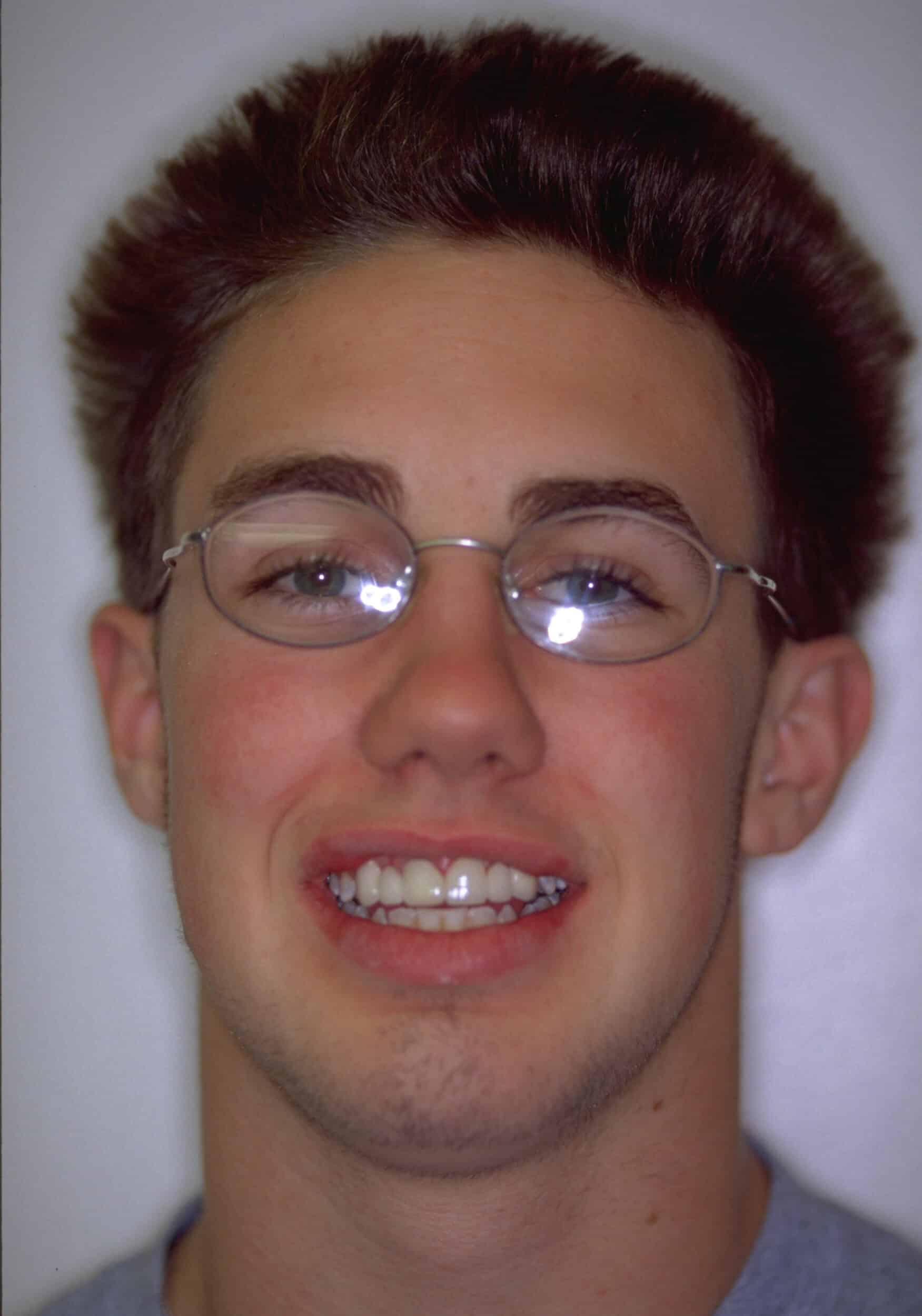 After Image: Dental Implants - front