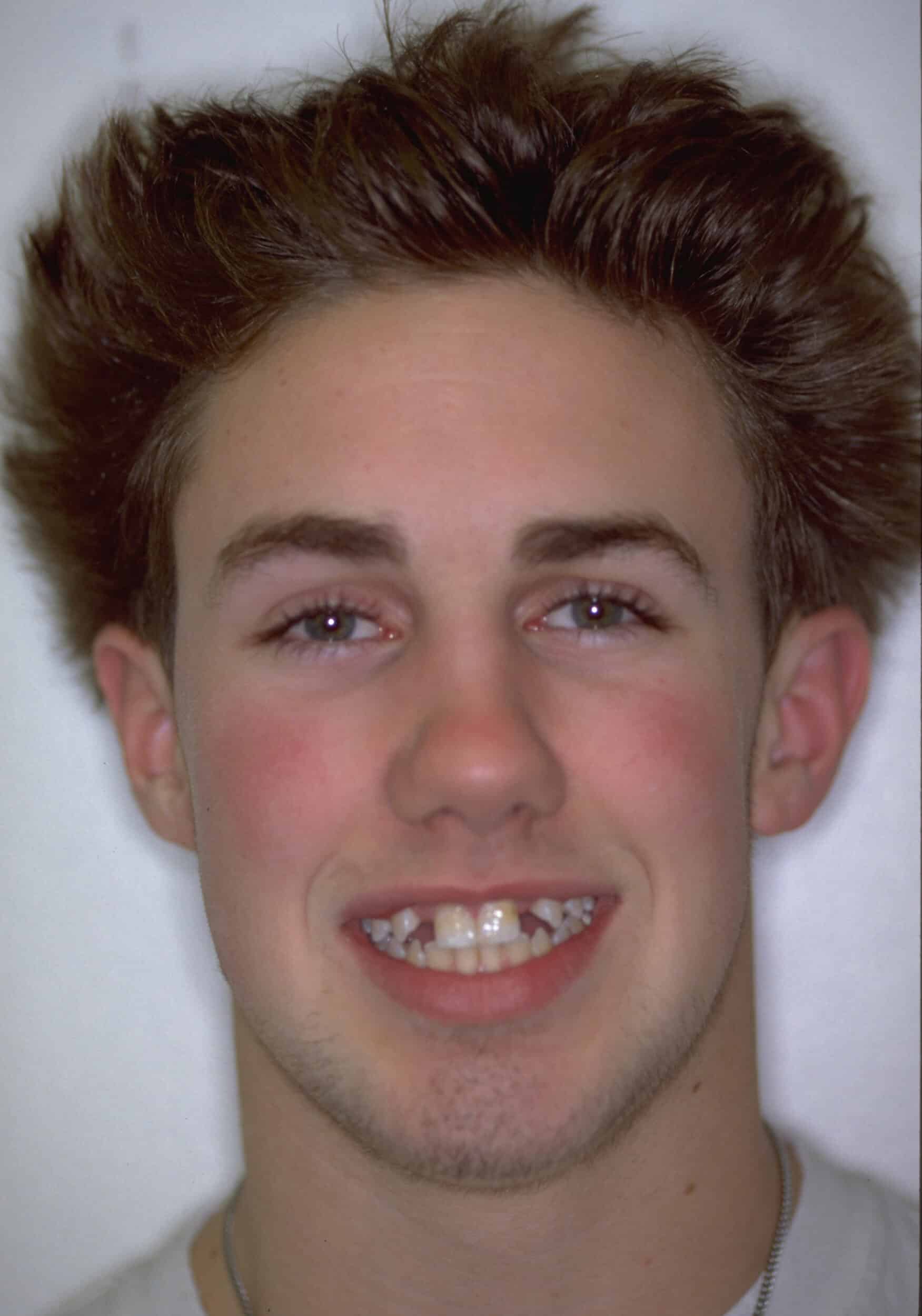 Before Image: Dental Implants - front