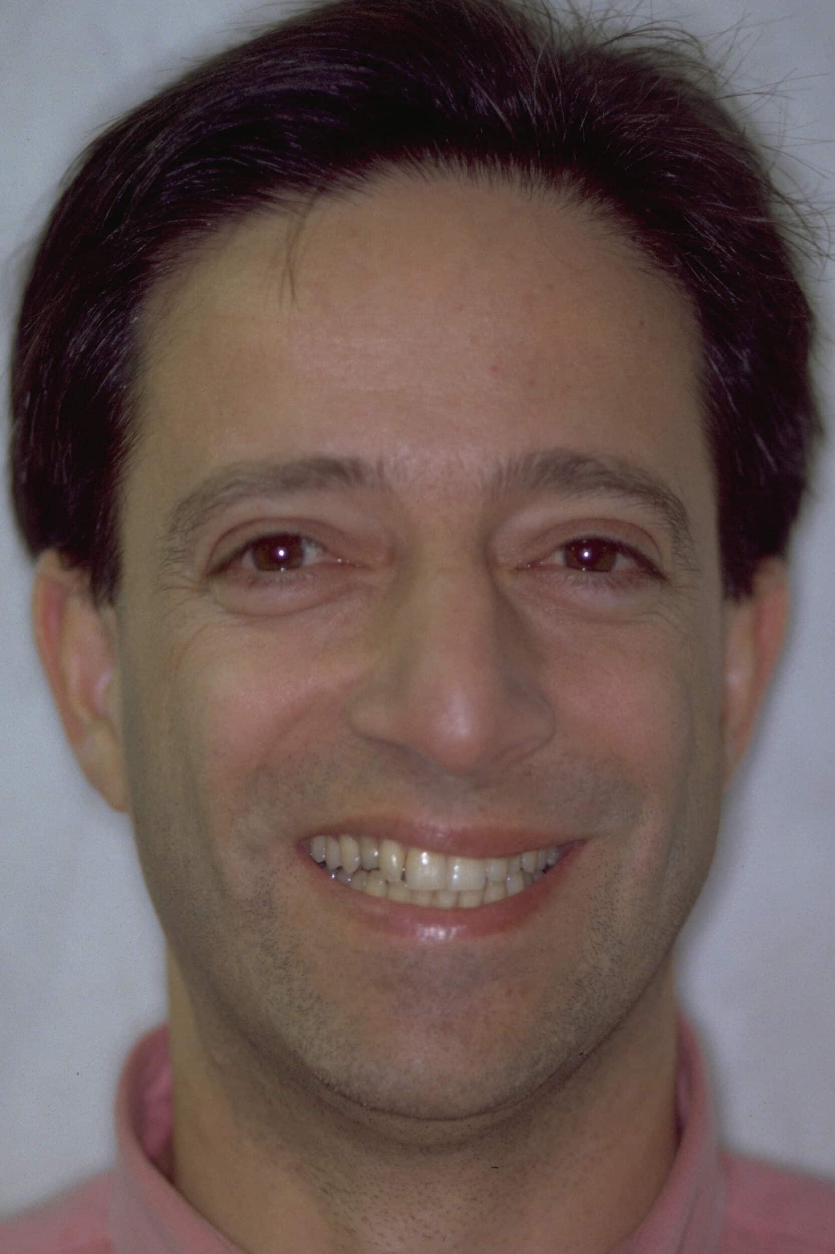 Before Image: Dental Implants - front