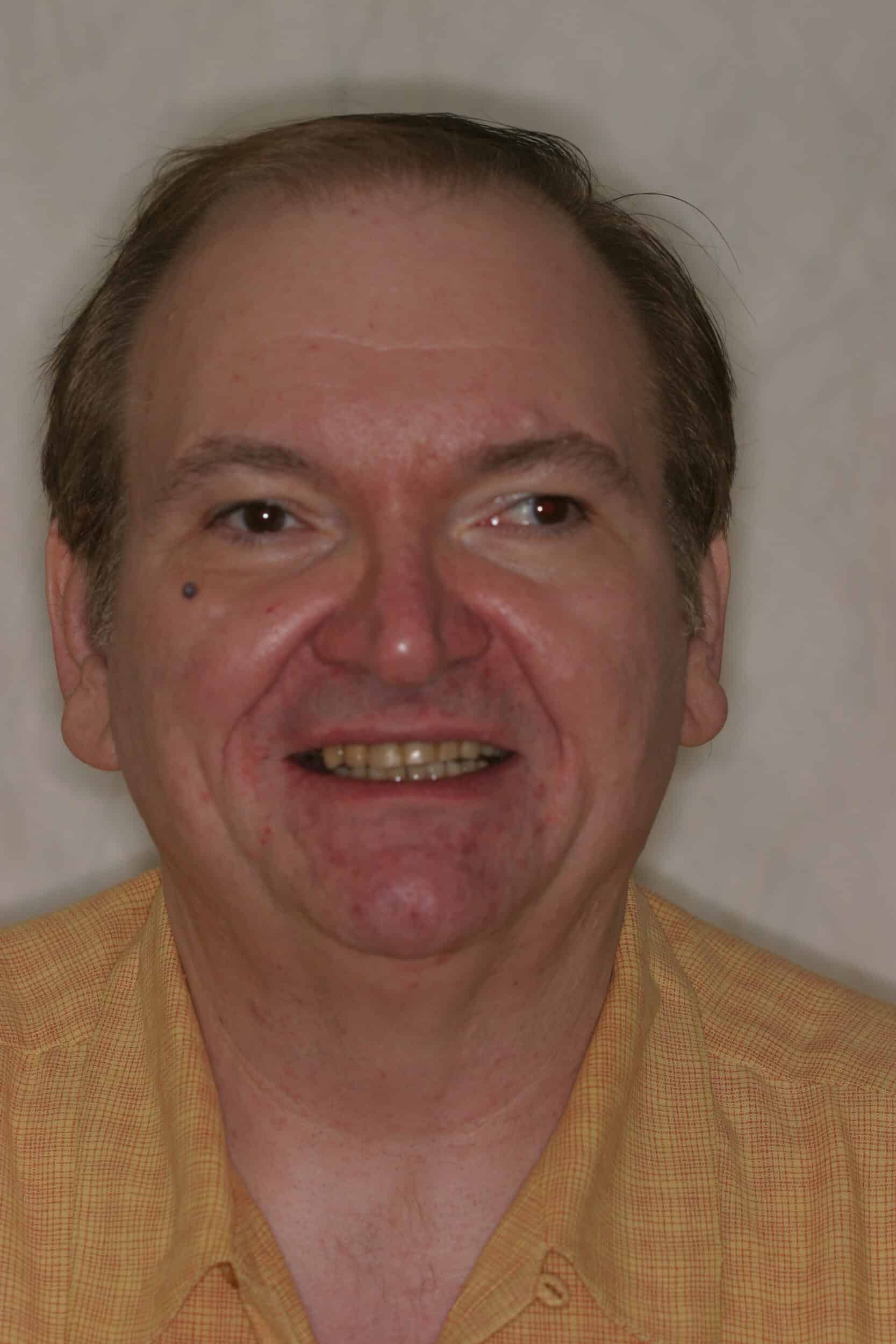 Before Image: Dental Implants - front