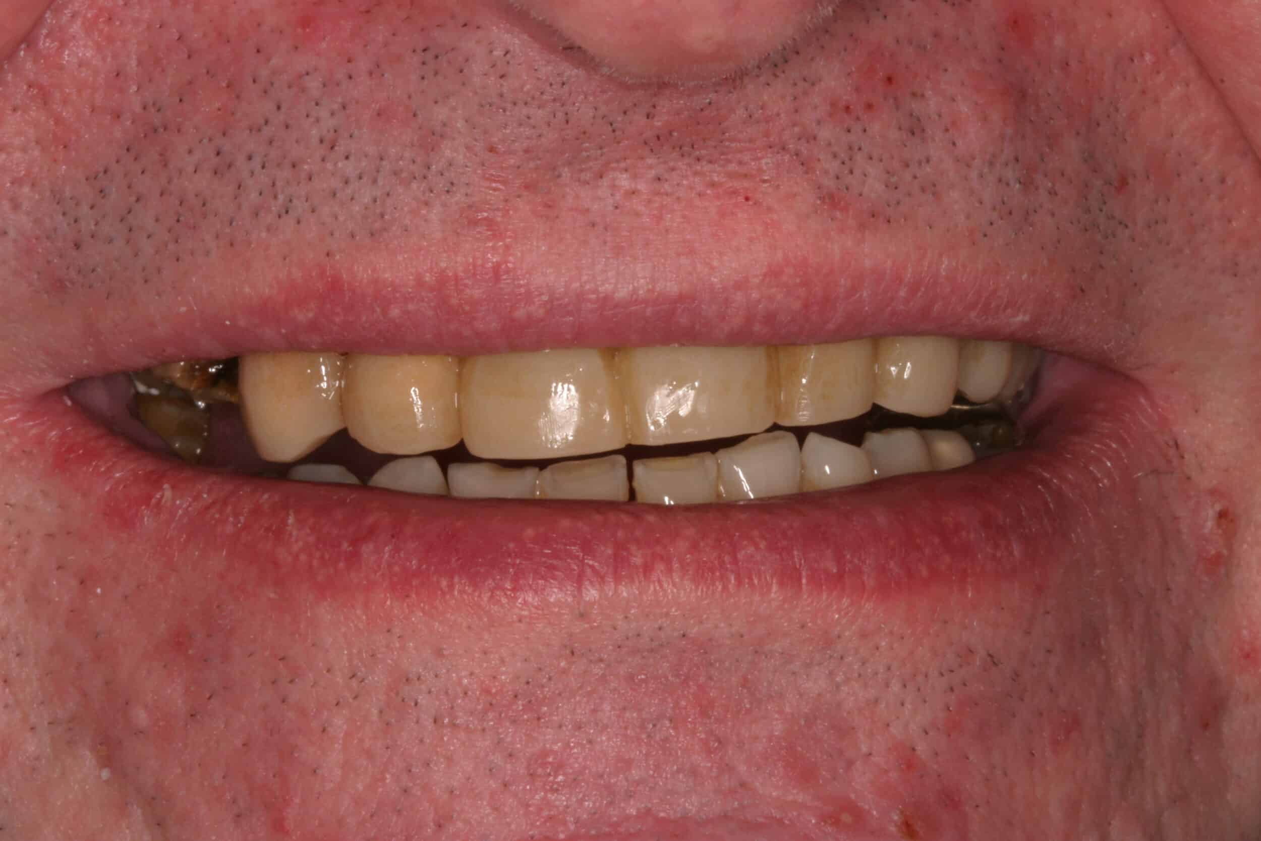 Before Image: Dental Implants - front
