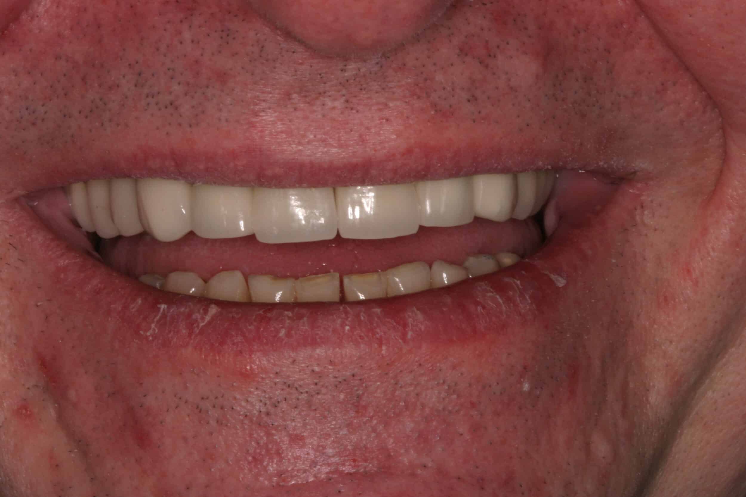 After Image: Dental Implants - front