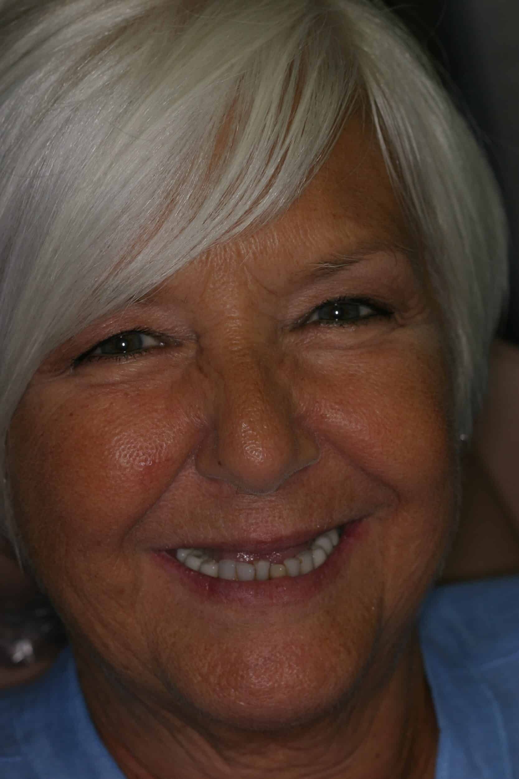 Before Image: Dental Implants - front