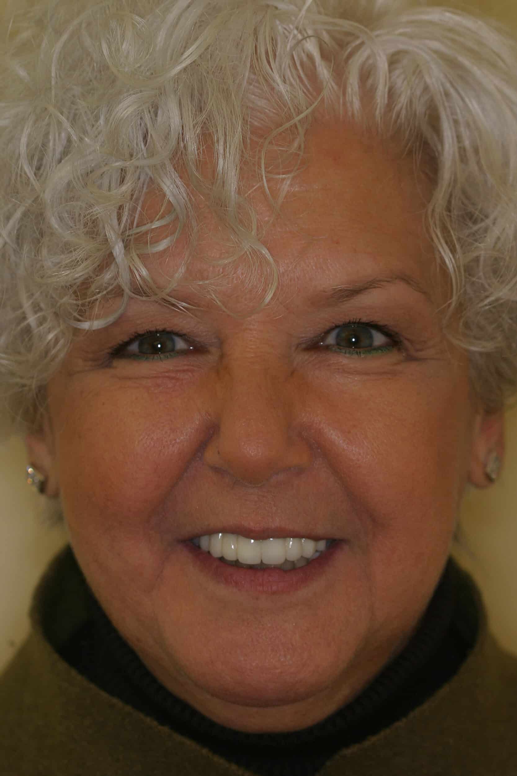 After Image: Dental Implants - front