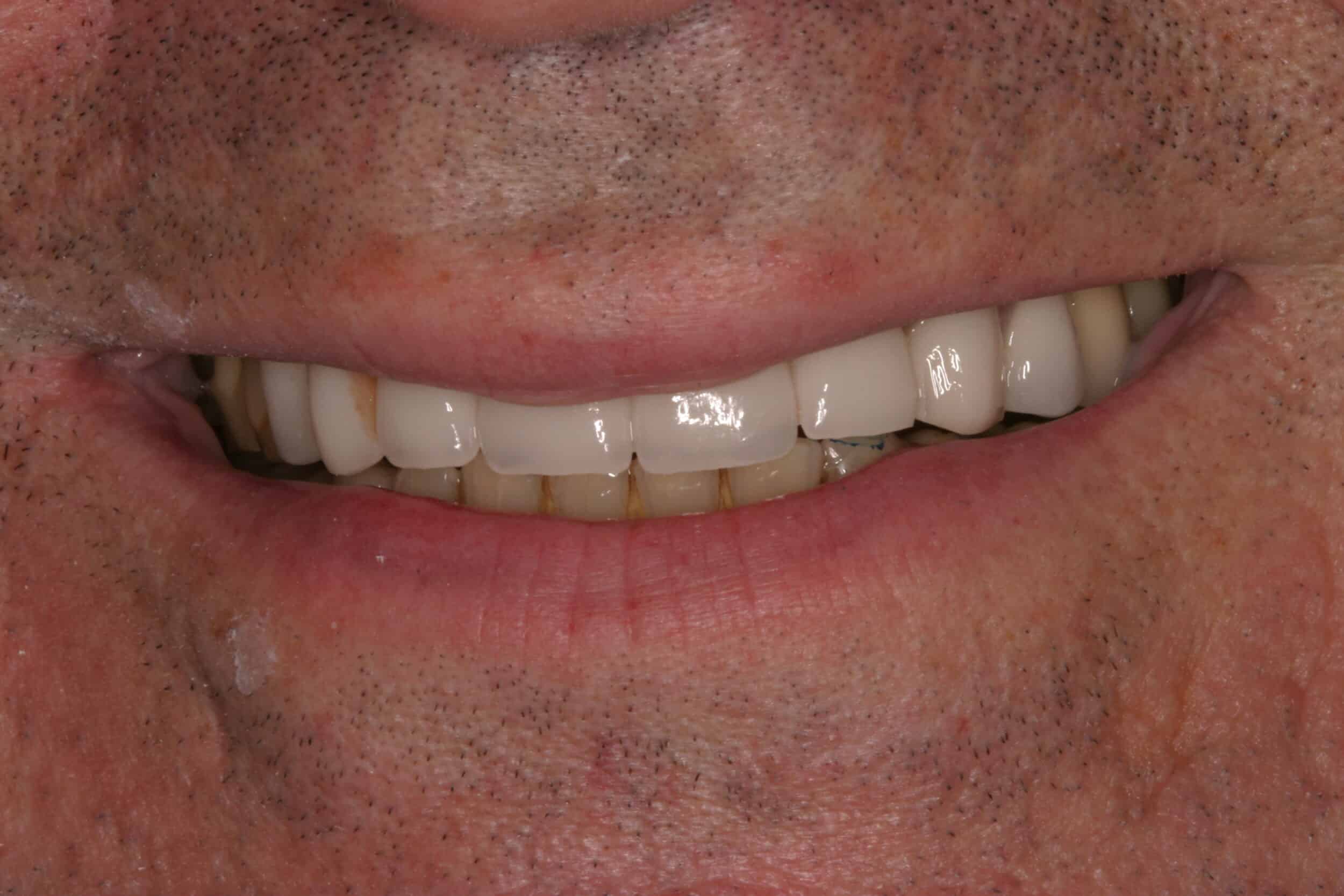 After Image: Dental Implants - front