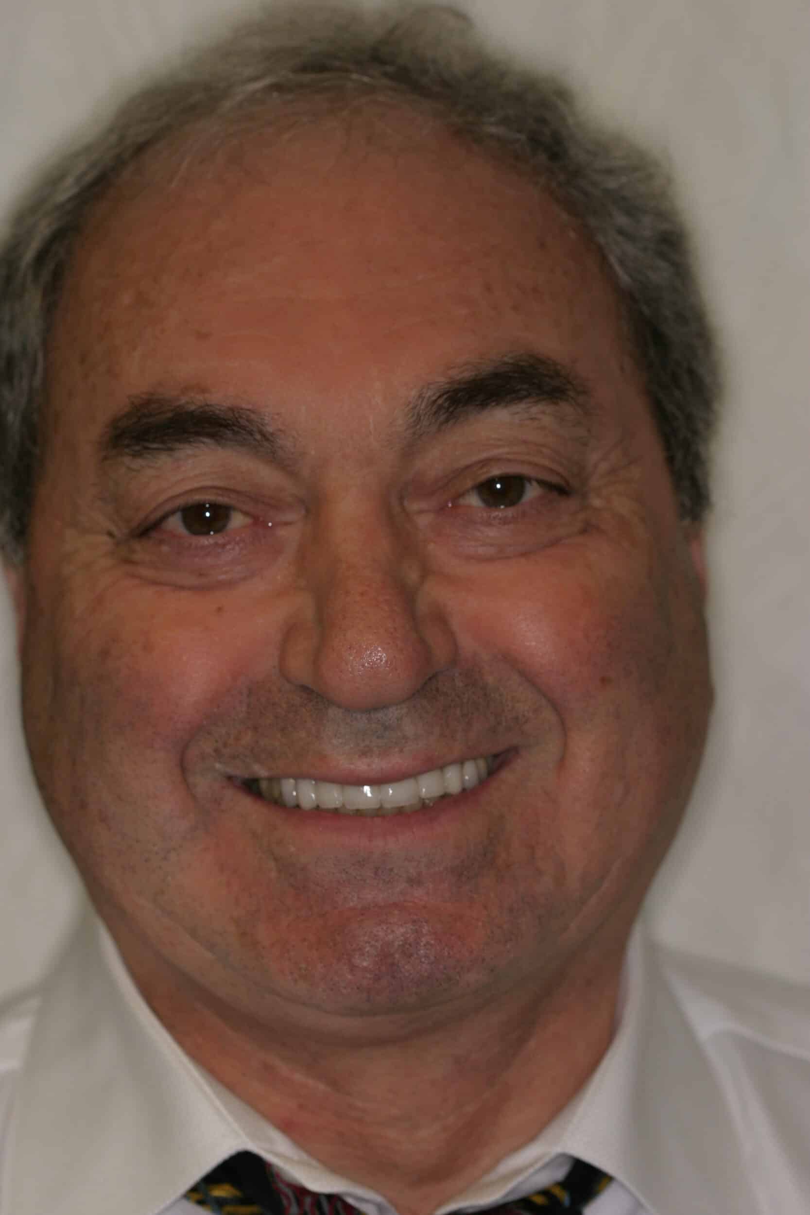 After Image: Dental Implants - front