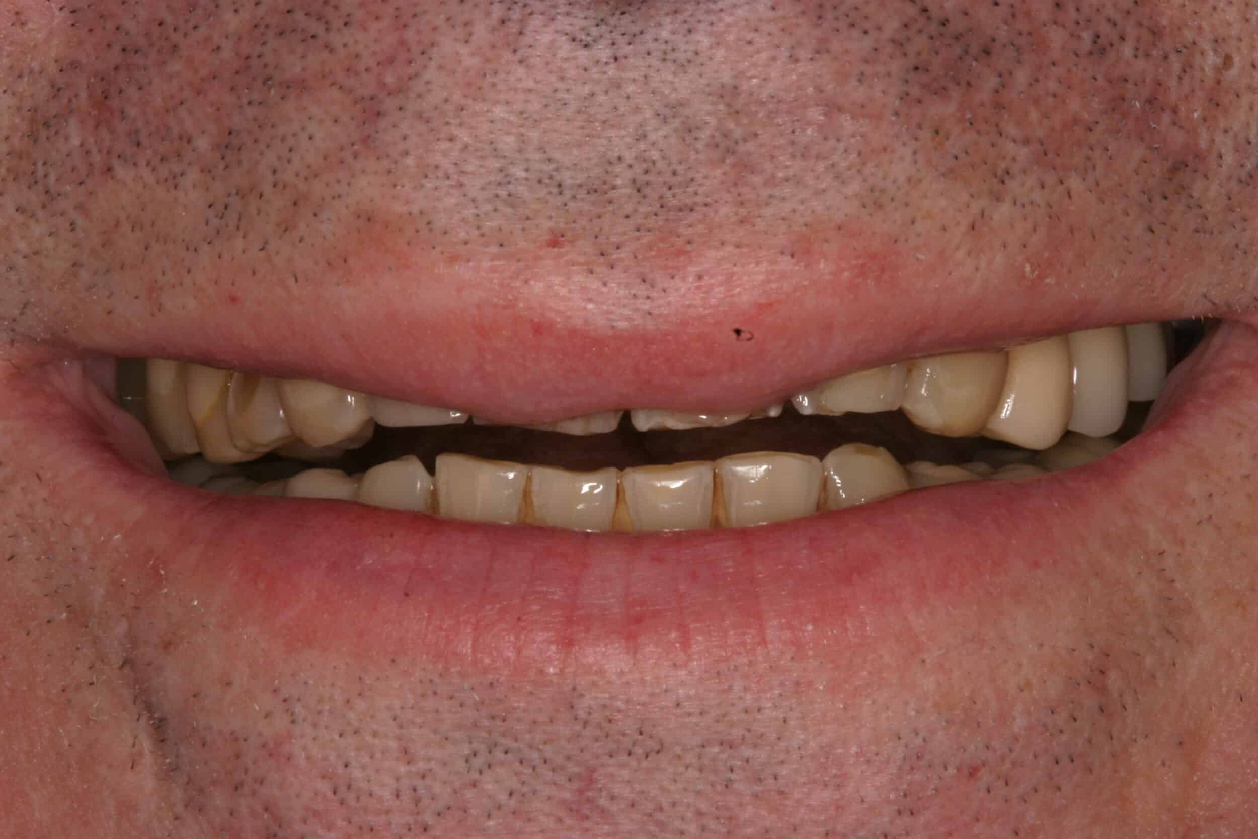 Before Image: Dental Implants - front