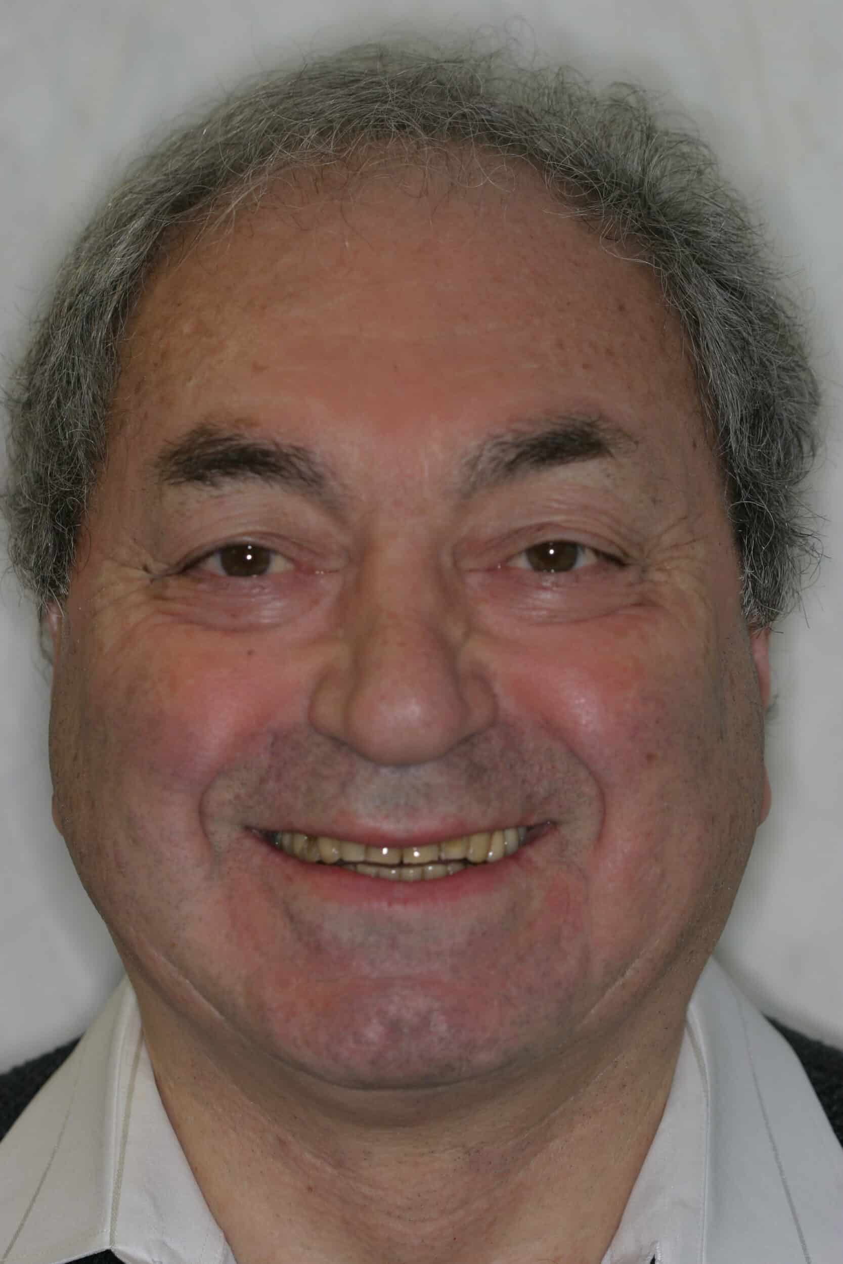 Before Image: Dental Implants - front