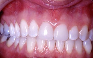 After Image: Veneer and Crown - front