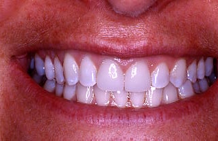 After Image: Veneer and Crown - front