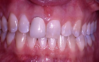 Before Image: Veneer and Crown - front