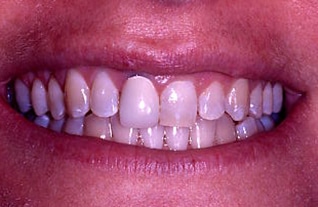 Before Image: Veneer and Crown - front