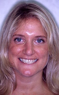 Before Image: Veneer and Crown - front