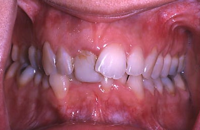Before Image: Veneers - front