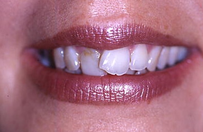 After Image: Veneers - front