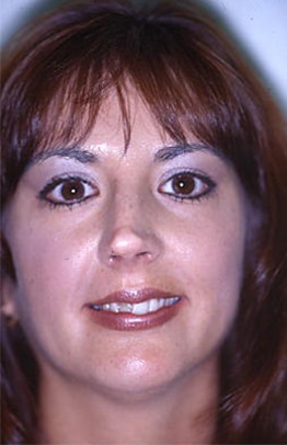 Before Image: Veneers - front