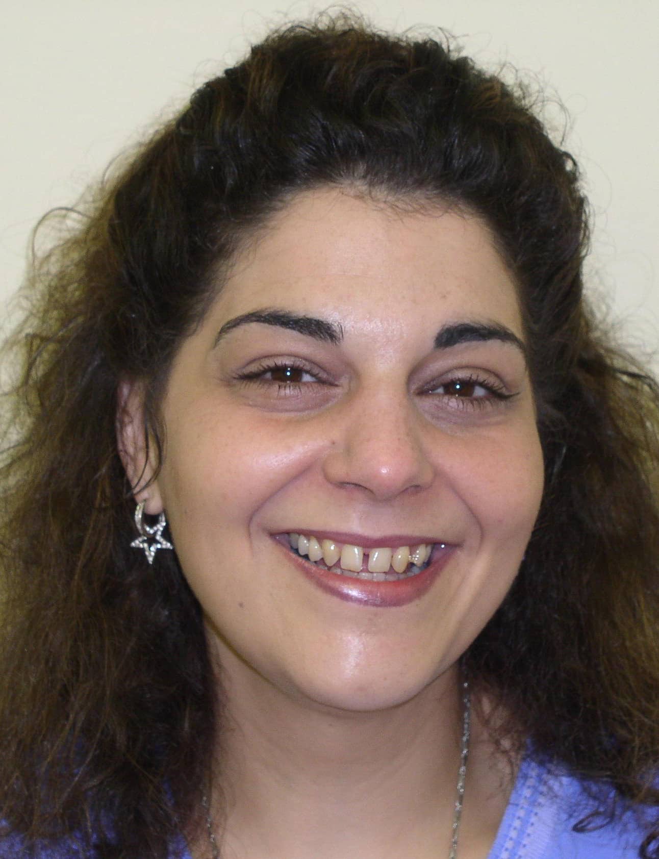 Before Image: Veneers - front