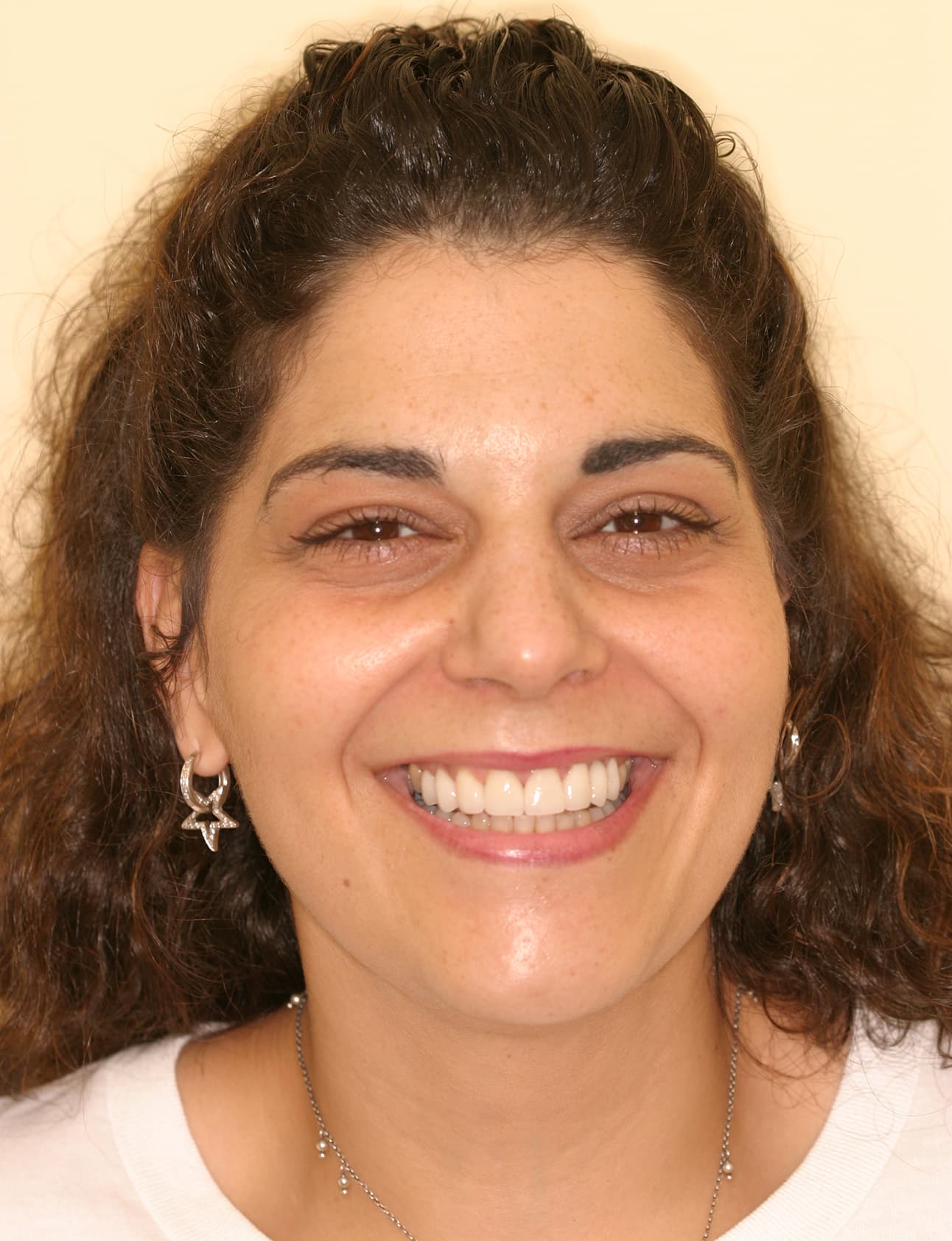 After Image: Veneers - front