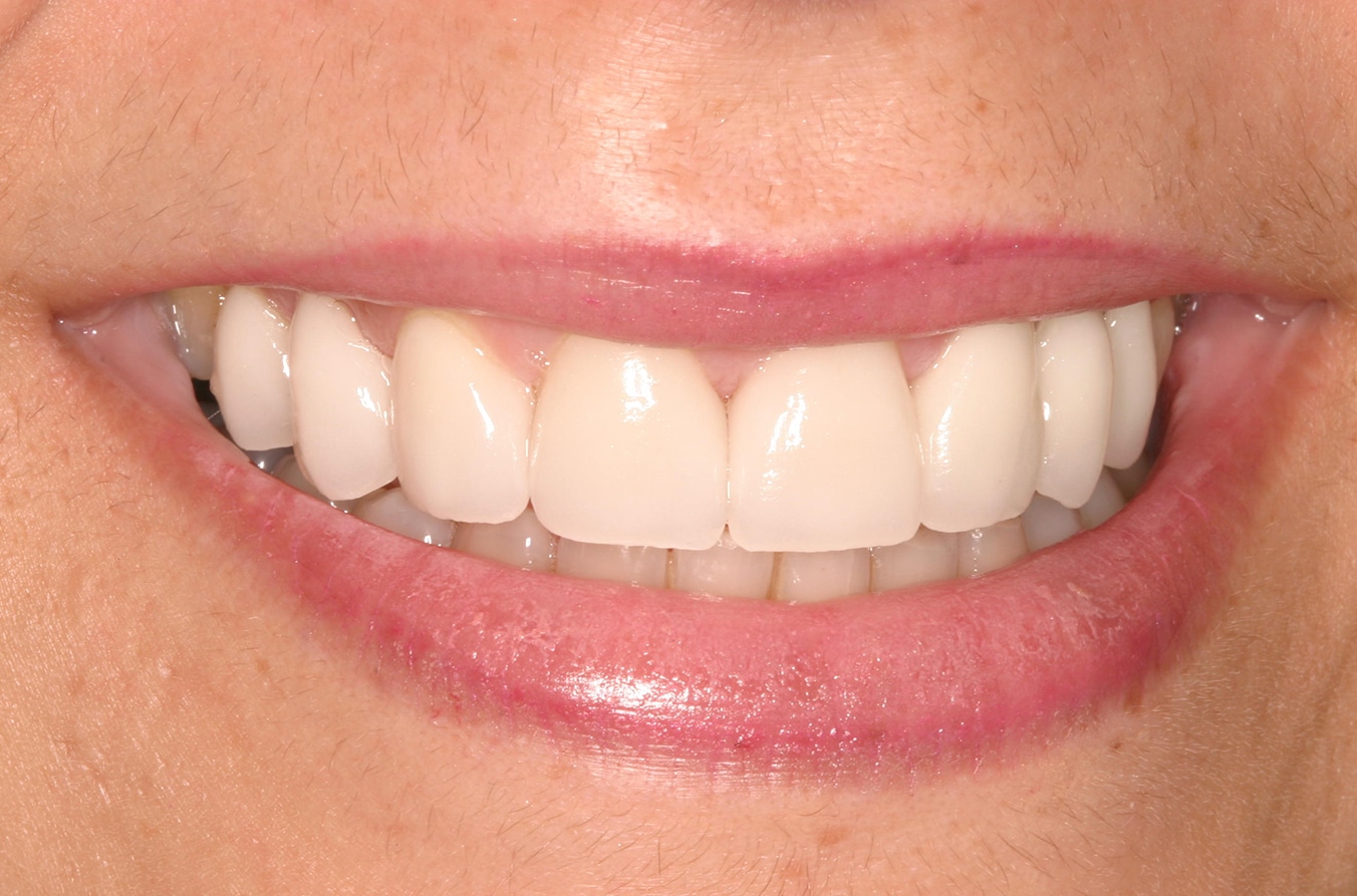 After Image: Veneers - front