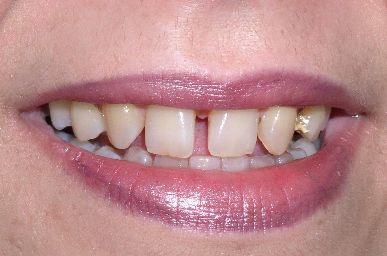 Before Image: Veneers - front