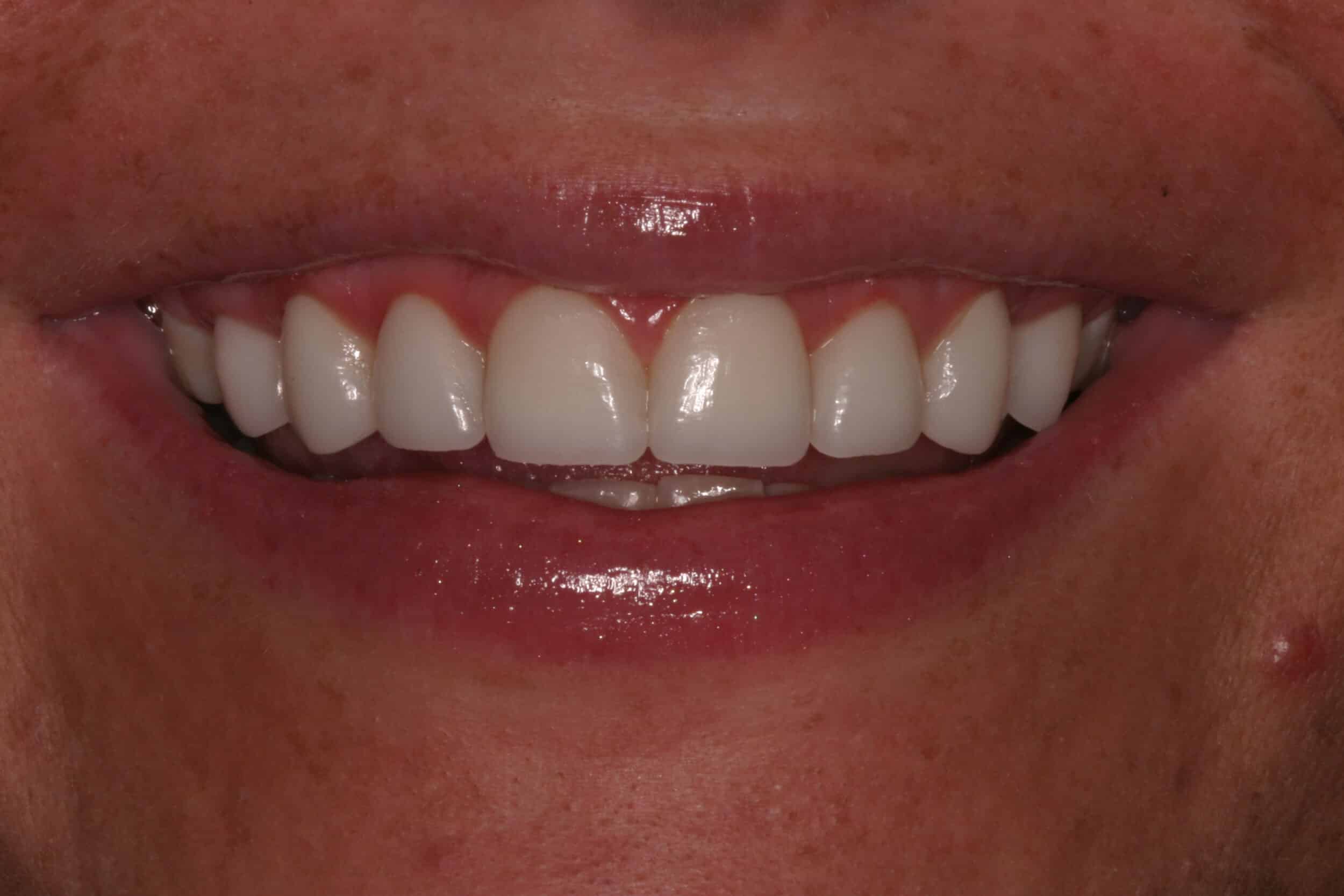 After Image: Veneers - front