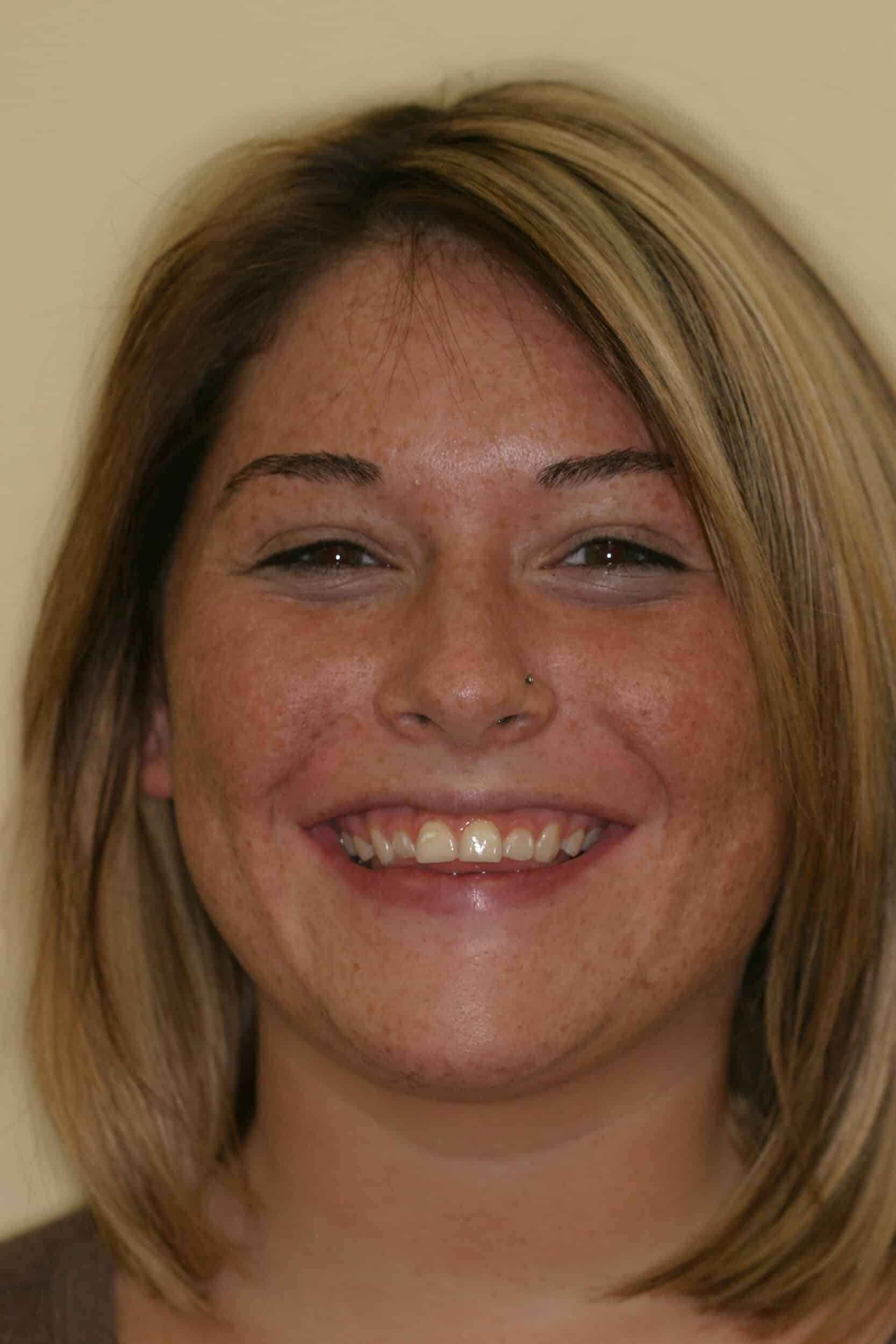 Before Image: Veneers - front
