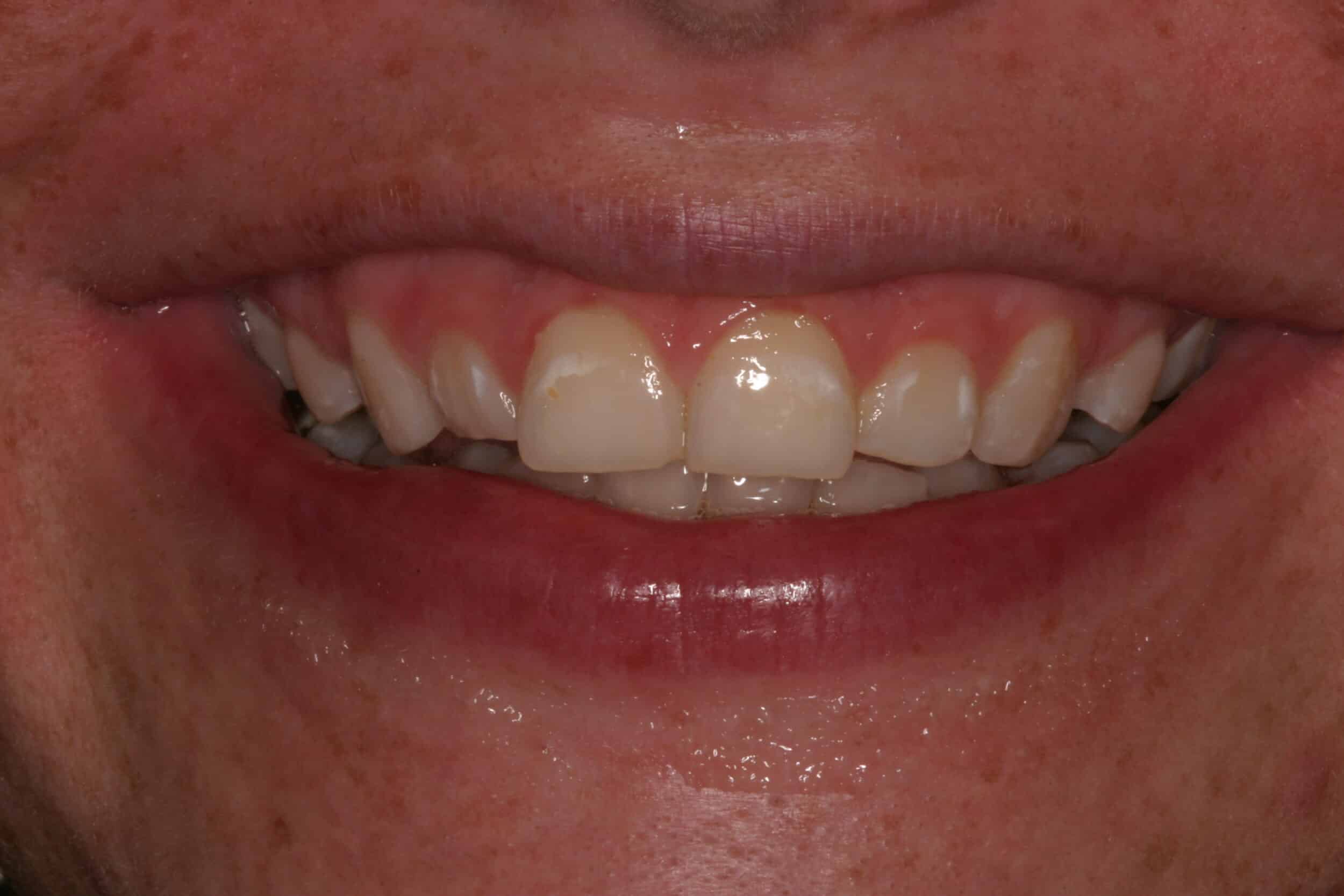 Before Image: Veneers - front