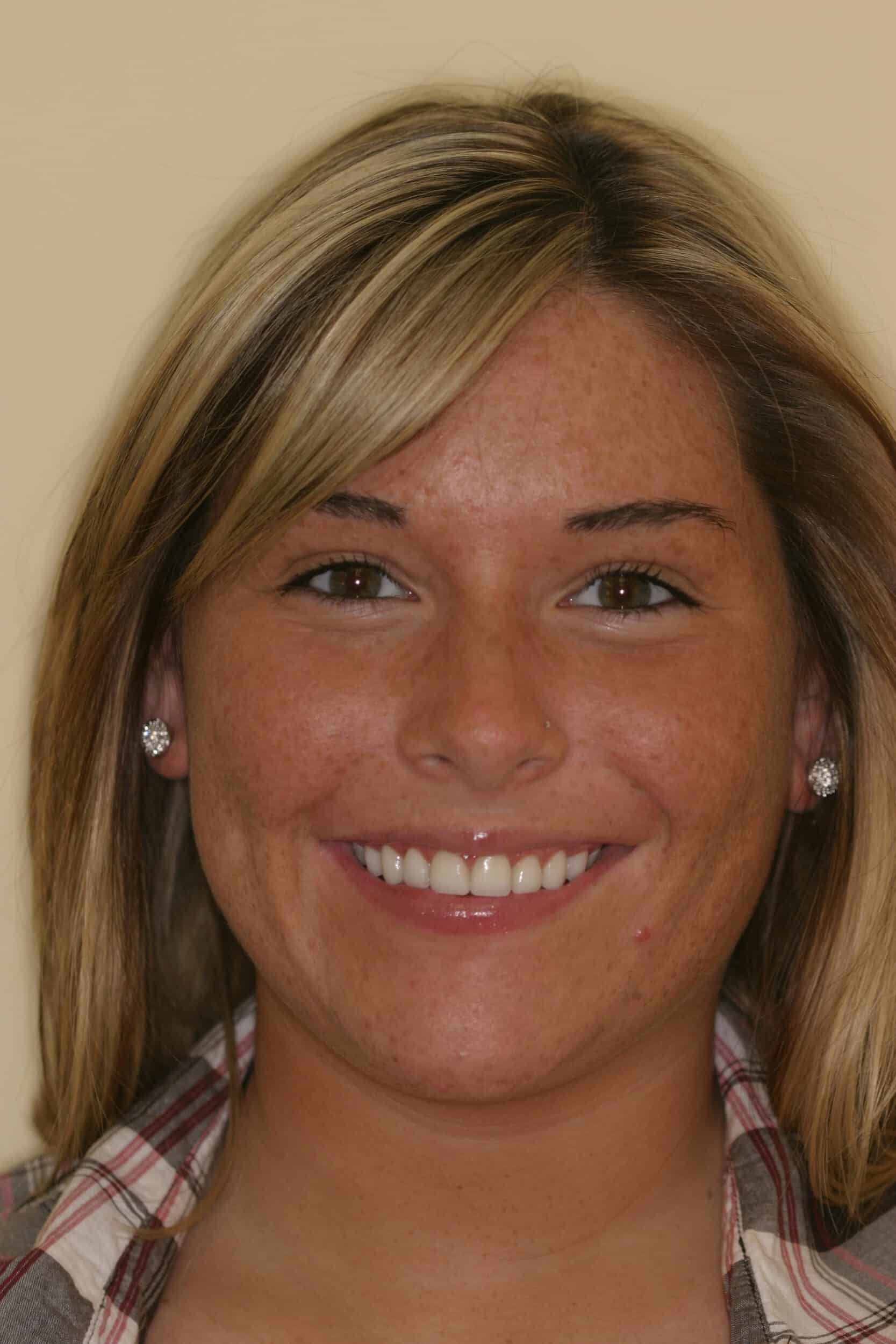 After Image: Veneers - front