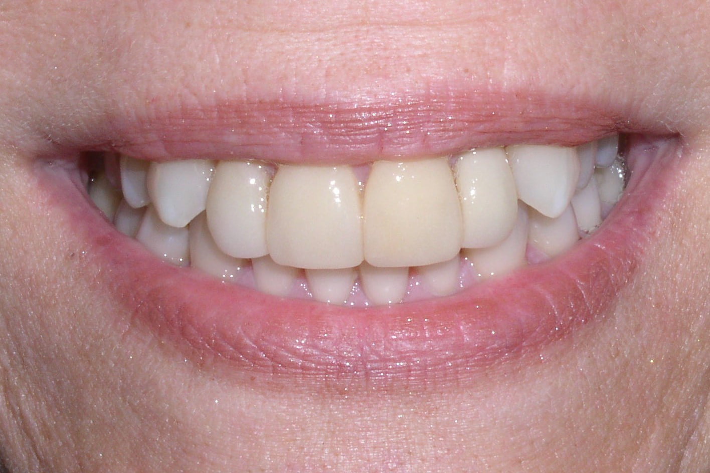 Before Image: Veneers - front