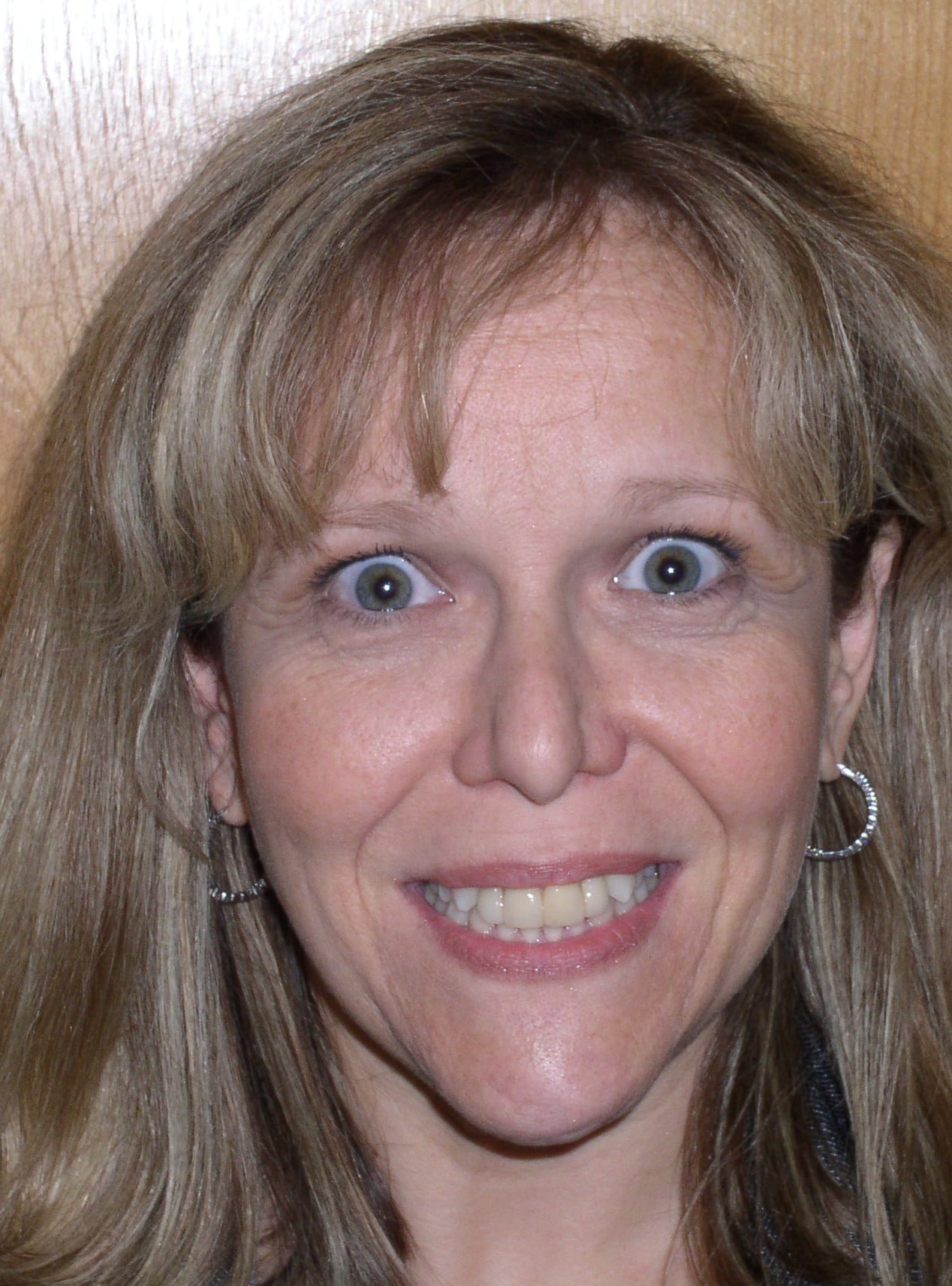 Before Image: Veneers - front