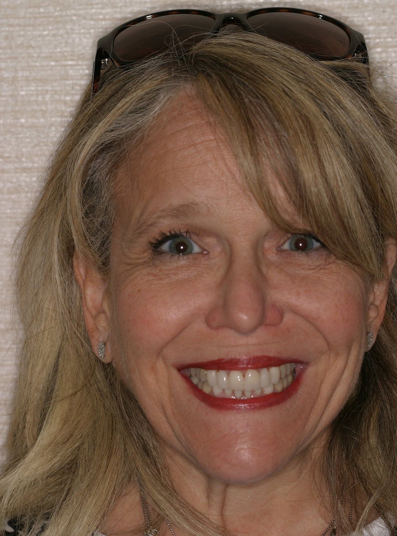 After Image: Veneers - front