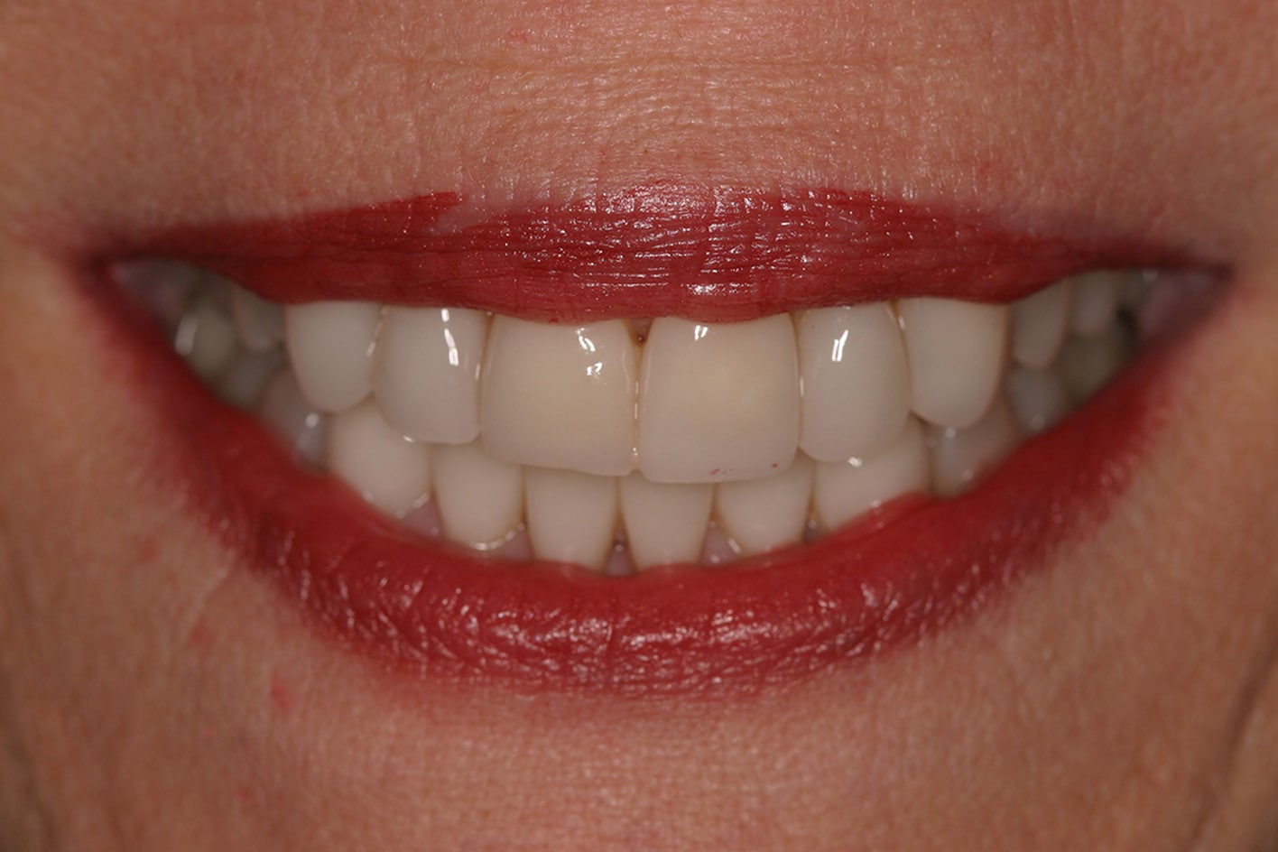 After Image: Veneers - front