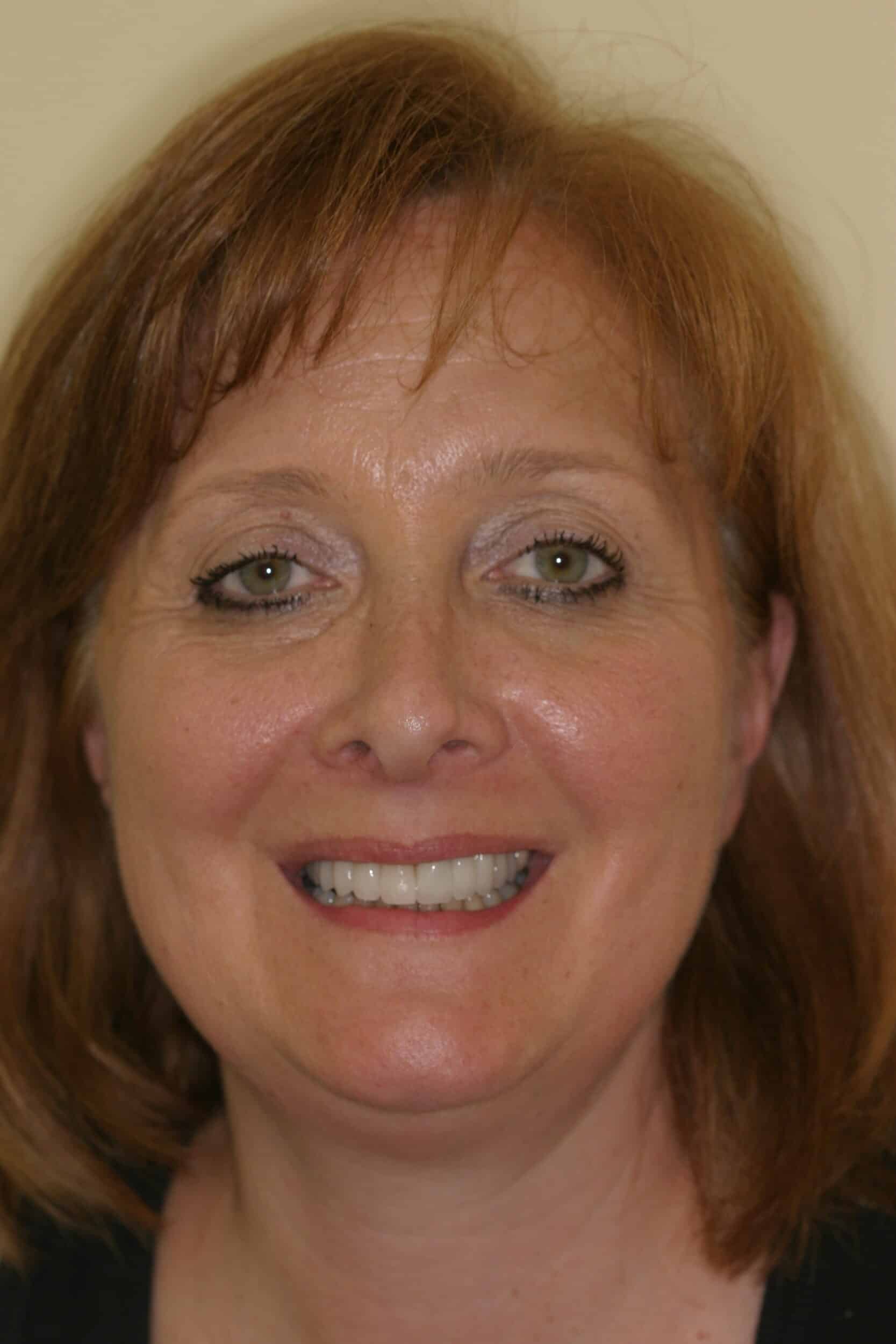 After Image: Veneers - front